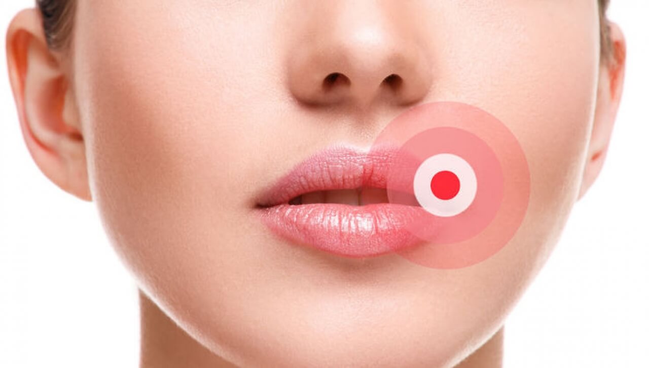 Лікар розповів, як зупинити герпес ще на початку Герпес