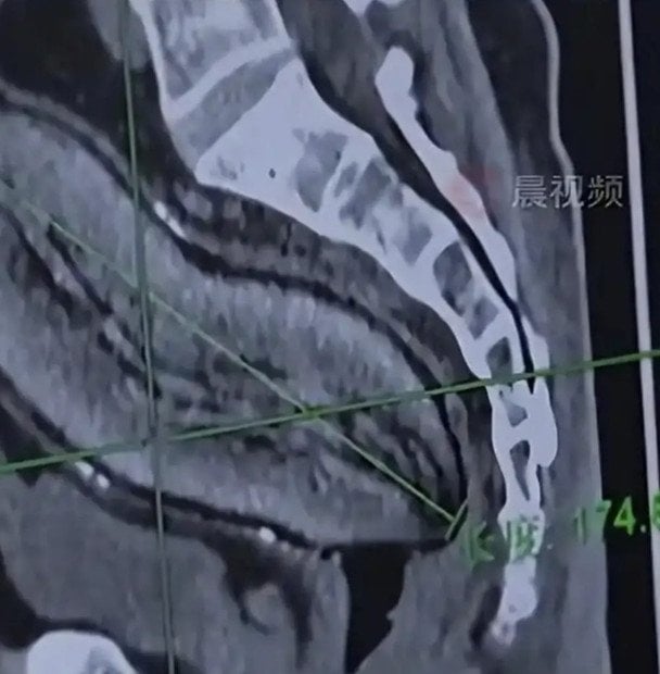 Батат у тілі чоловіка / © Jam Press