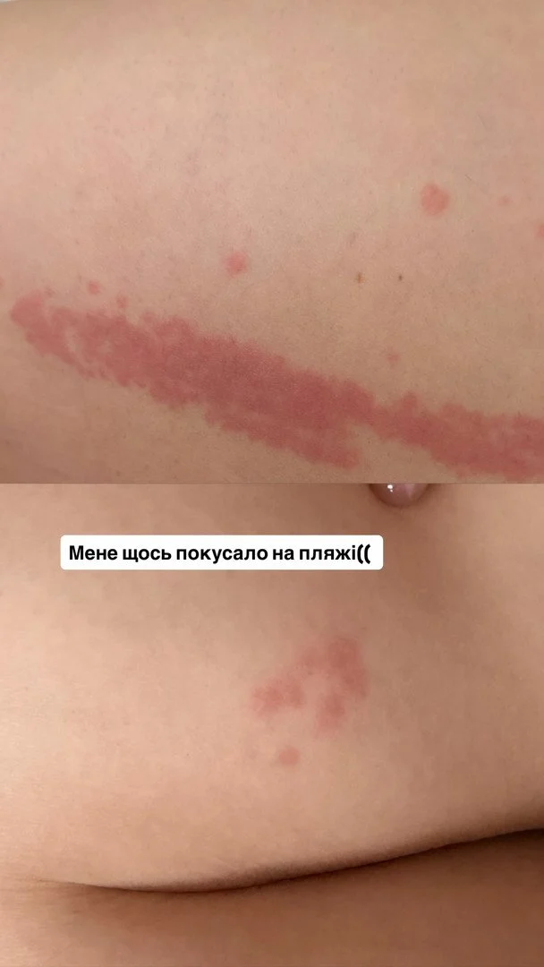 Анна Трінчер пожалілась на висипання на тілі / © instagram.com/annatrincher_official