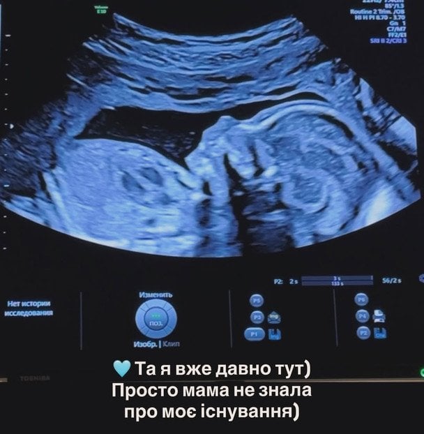 Артистка протягом п'яти місяців навіть не здогадувалась, що знову вагітна / © instagram.com/annasagaidachnaya