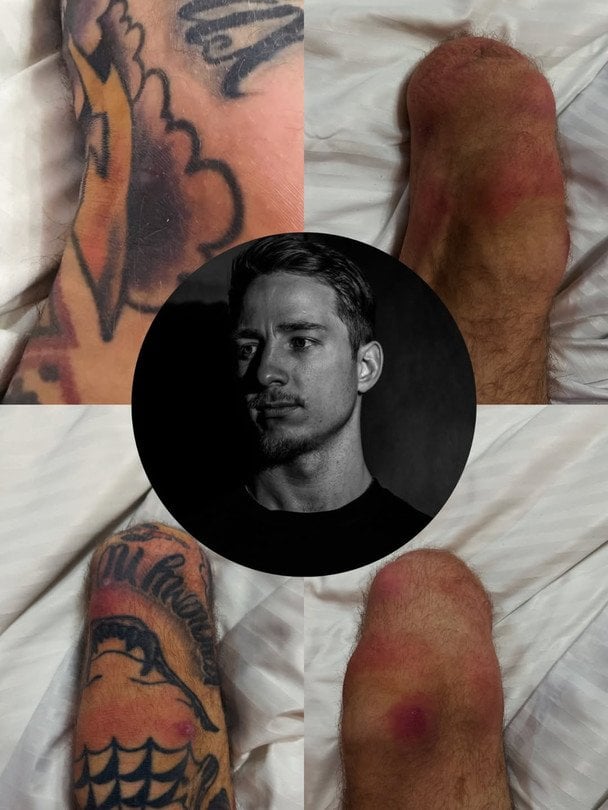 Олександру Терену дається взнаки носіння протезів / © instagram.com/tsvit_terenu